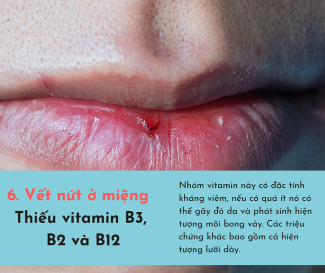 Cơ thể bị cạn kiệt vitamin sẽ phát ra 6 dấu hiệu, chủ quan bỏ qua có thể tổn thọ - Ảnh 6.