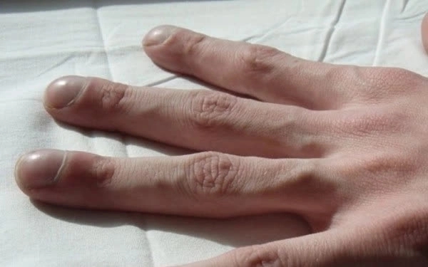 3 thay đổi ở ngón tay báo hiệu nhiều bệnh ung thư nhưng ít ai để ý - Ảnh 2.
