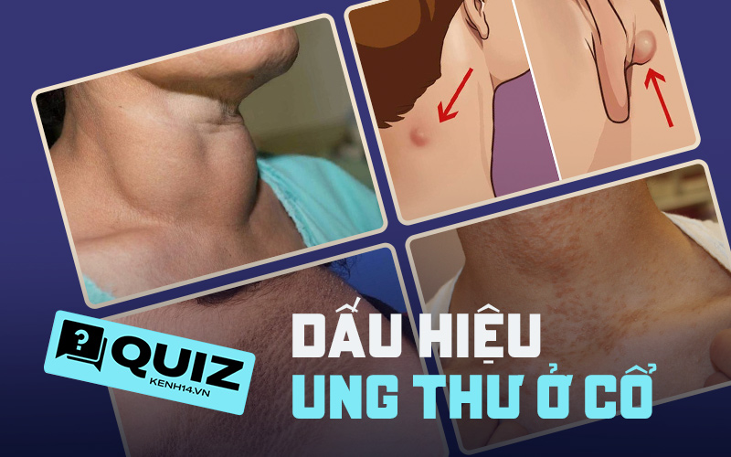 Quiz: Bạn có đang gặp phải những dấu hiệu cảnh báo tế bào ung thư ở vùng cổ không? - Ảnh 1.