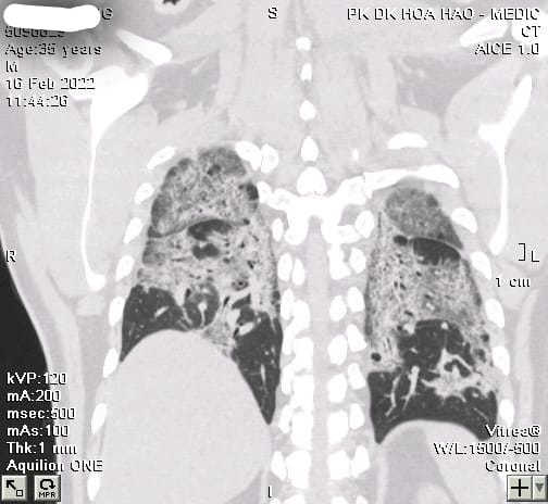 F0 không có triệu chứng, phổi vẫn trắng xoá hậu Covid-19