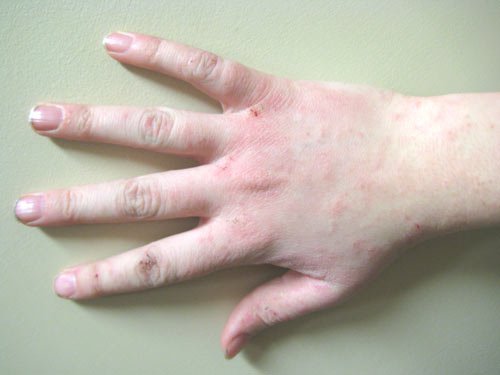 Người có lượng đường trong máu cao thường có 3 dấu hiệu bất thường này ở bàn tay - Ảnh 1.