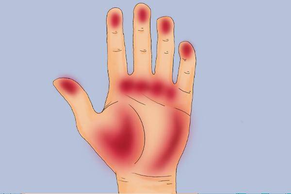 2 hiện tượng bất thường xuất hiện ở lòng bàn tay, lòng bàn chân cảnh báo tế bào ung thư đang nhen nhóm phát triển - Ảnh 2.