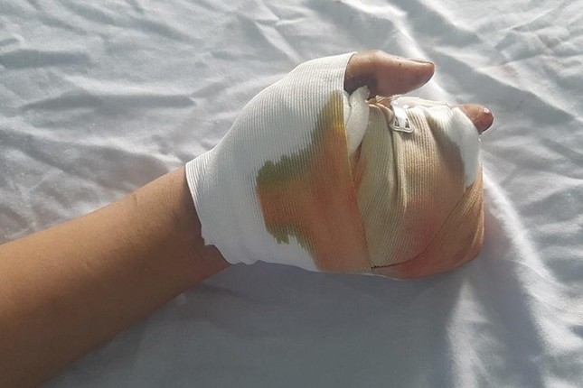 Thiếu niên bị nát bàn tay, lộ xương vì pháo tự chế - Ảnh 2.