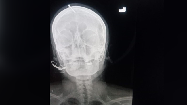 Thai phụ mang bầu bé gái, thầy lang dỏm hứa chuyển giới thai nhi trong bụng thành trai bằng biện pháp không tưởng, ảnh chụp X-quang gây sốc - Ảnh 1.