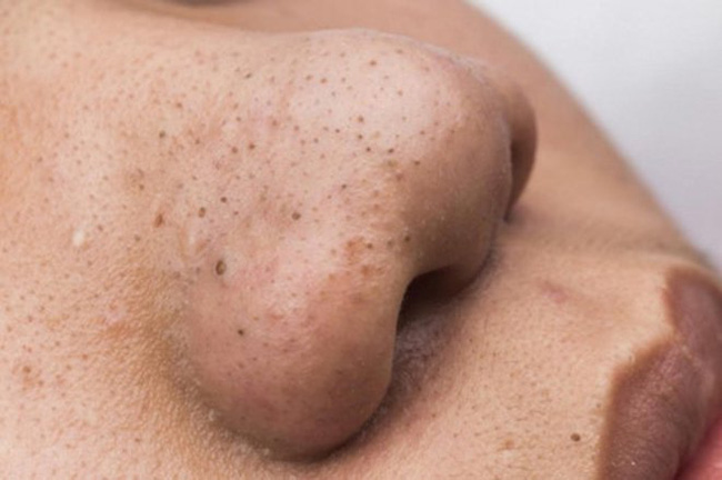 Skincare sau khi sửa mũi: Tránh tuyệt đối bước này nếu không muốn mũi vẹo, lệch tan nát - Ảnh 6.