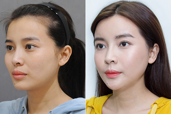 Diễn vi&ecirc;n Việt lạm dụng dao k&eacute;o: Người thăng hạng cả visual lẫn sự nghiệp, người tự dưng diễn đơ lạ l&ugrave;ng - Ảnh 7.
