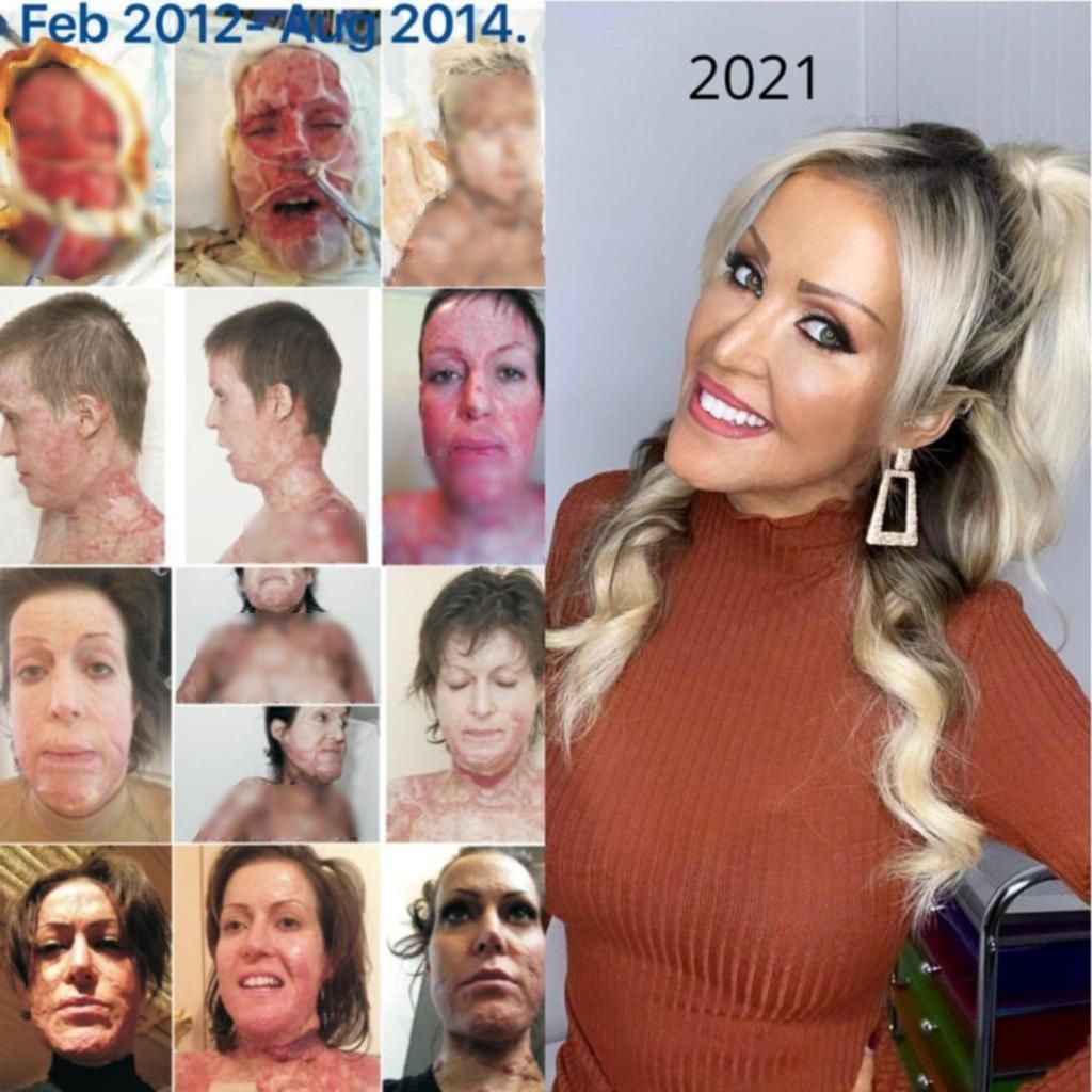 Bị thiêu sống, người phụ nữ biến thành “quái vật” bỏng toàn thân, hình ảnh sau 10 năm trải qua 200 cuộc phẫu thuật khiến thế giới kinh ngạc - Ảnh 3.