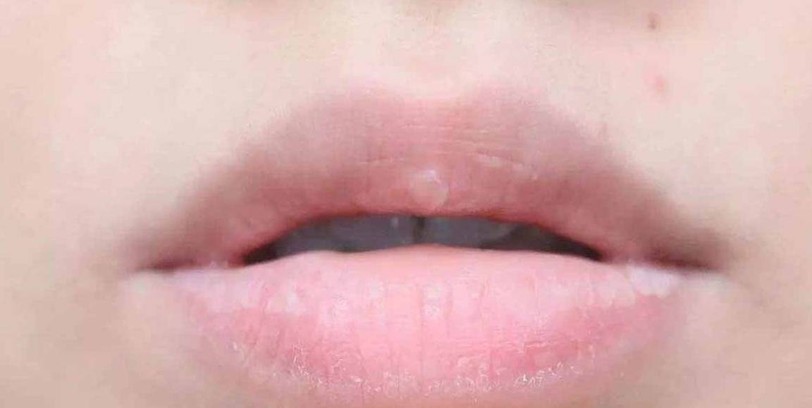 4 dấu hiệu xuất hiện ở vùng miệng cho thấy sự xuất hiện của bệnh viêm nhiễm phụ khoa, nếu không có cái nào thì xin chúc mừng - Ảnh 1.
