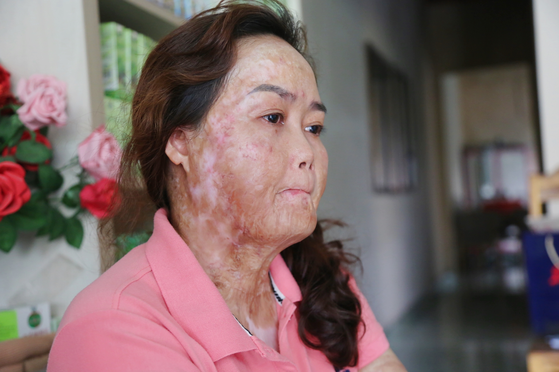 The woman was burned alive by her husband with gasoline and burned 92%: the past 3 years have been like a nightmare, she is in great pain but has to live for her children - Photo 5.