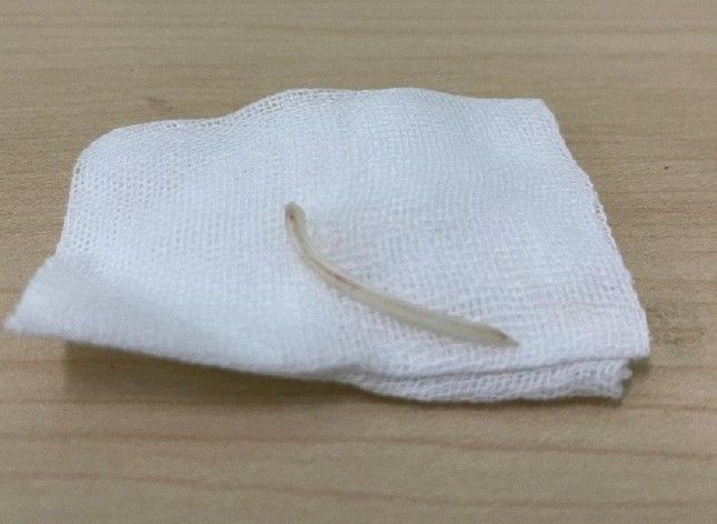 Giật mình khi ăn cá, người đàn ông bị xương ghim vào dây thanh quản - Ảnh 2.