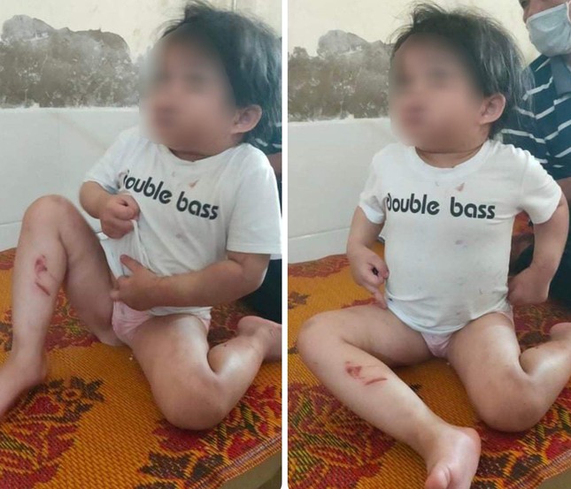 Ha Tinh: 4-year-old girl admitted to the hospital suspected of being abused - Photo 1.