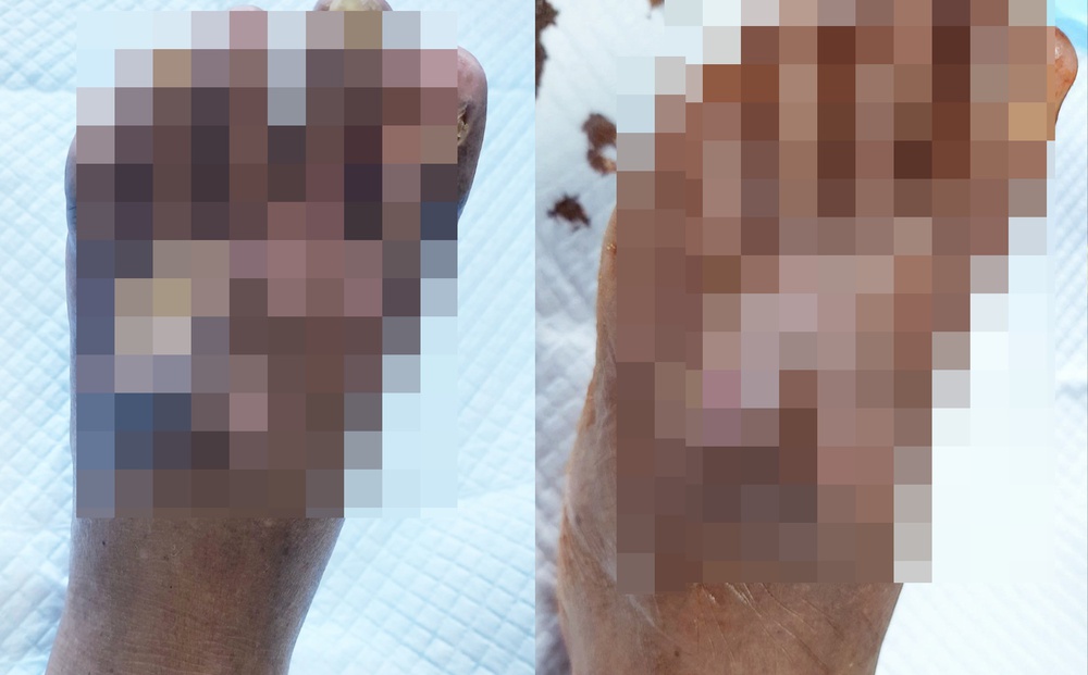 The man almost lost his leg due to a blood vessel blockage after COVID-19 - Photo 1. The man almost lost his leg due to a blood vessel blockage after COVID-19 - Photo 1.