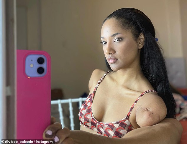 Bị điện giật mất 2 tay v&agrave; 1 ch&acirc;n từ nhỏ, 20 năm sau c&ocirc; g&aacute;i với nghị lực phi thường trở th&agrave;nh mỹ nh&acirc;n khiến cả thế giới ngưỡng mộ - Ảnh 3.