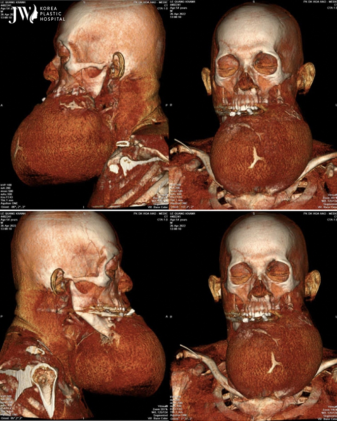 Race to save a man for 10 years with a giant tumor on his face - Photo 2.