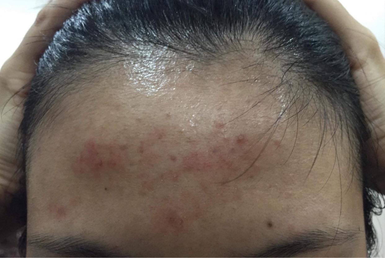 Bị mụn dai dẳng suốt 1 năm, m&igrave;nh đ&atilde; t&igrave;m ra chu tr&igrave;nh dưỡng da, trị mụn với c&aacute;c sản phẩm b&igrave;nh d&acirc;n chỉ từ 92k - Ảnh 1.