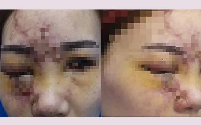 Filler injection disguised as collagen, many people experience complications - Photo 2.