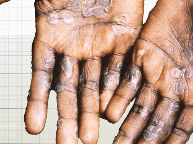 He recorded cases of monkeypox in the community - Photo 1.