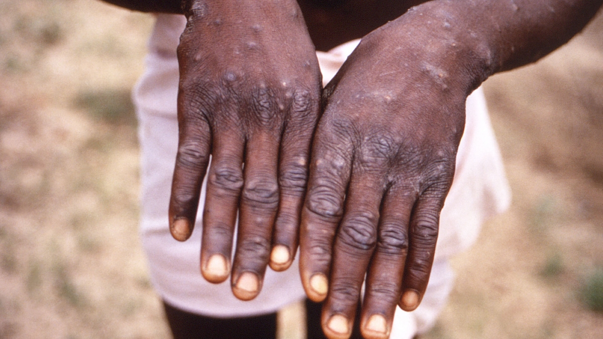 Expert: Monkey smallpox is unlikely to spread into a pandemic - Photo 1.