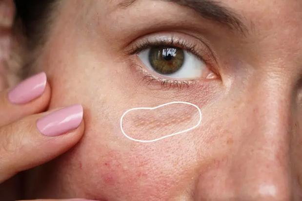 Mụn thịt chữa c&aacute;ch g&igrave;? - Ảnh 3.