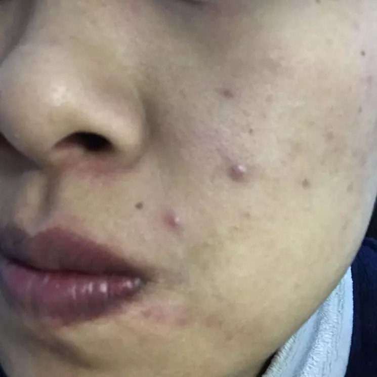 An 18-year-old female student suddenly had acne on her face, thought she was stressed because of the university exam, who suspected that she had HPV infection even though she had never had sex and had no boyfriend - Photo 1.