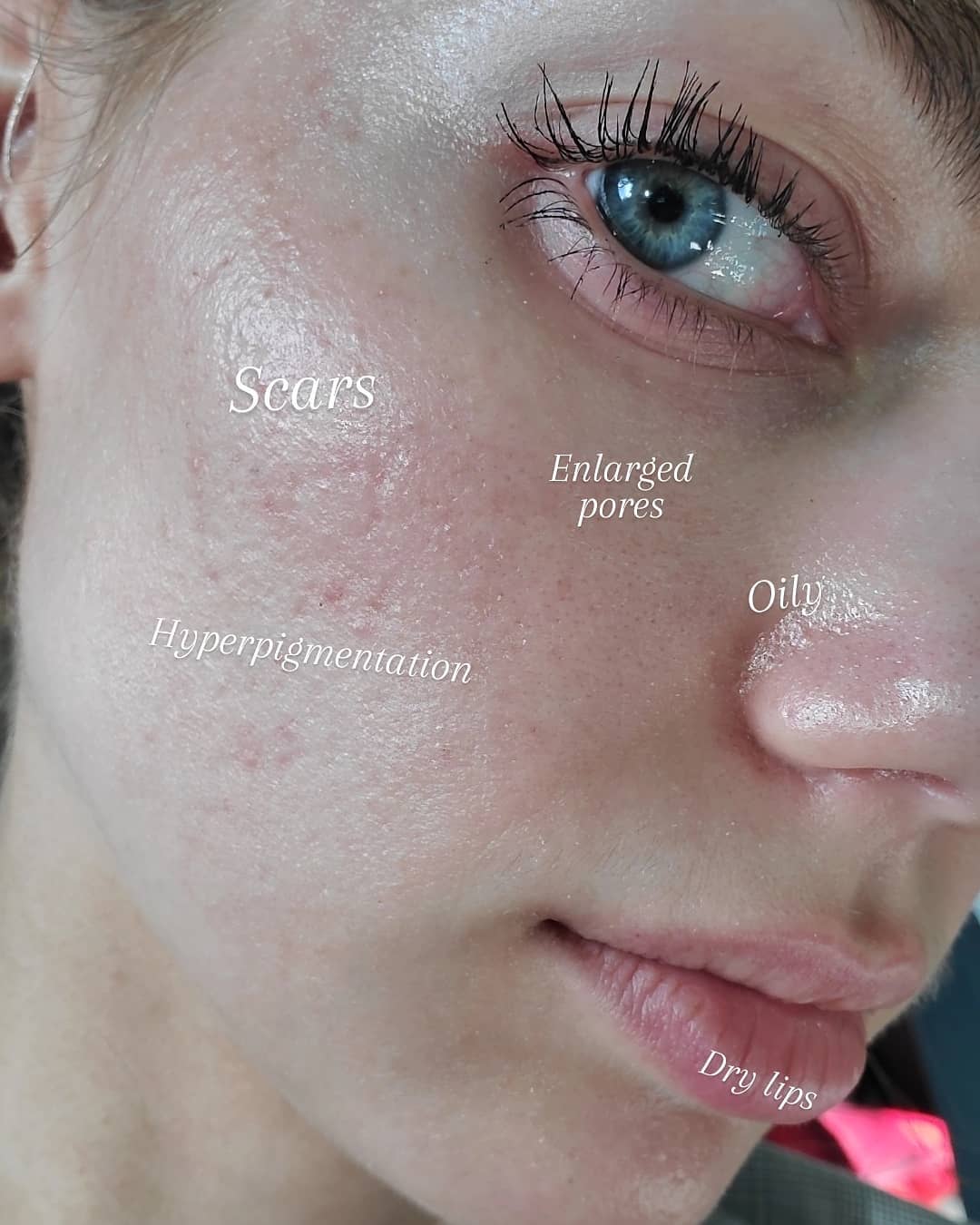 For oily skin: The dermatologist clearly shows the skincare step to balance all types of oil in the summer - Photo 2.