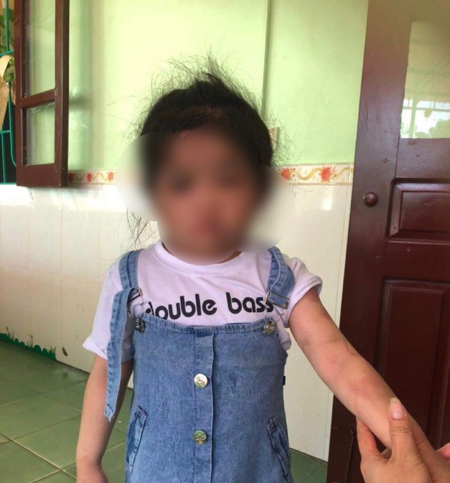 Prosecution of the case that the biological aunt used an iron broom to beat the 4-year-old grandchild to the hospital because he was lazy to eat - Photo 1.