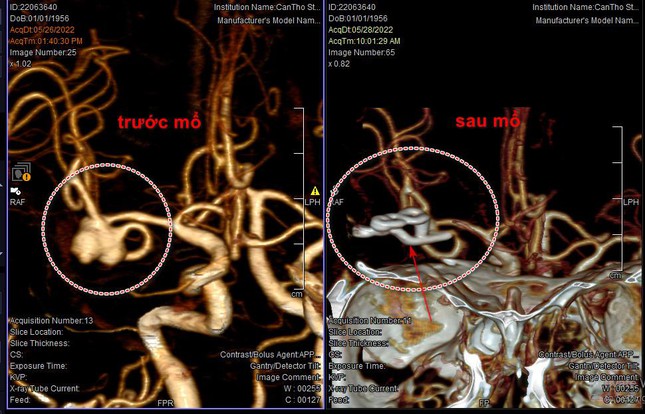 Lifting up her voice when singing karaoke, the singer burst a cerebral blood vessel - Photo 1.