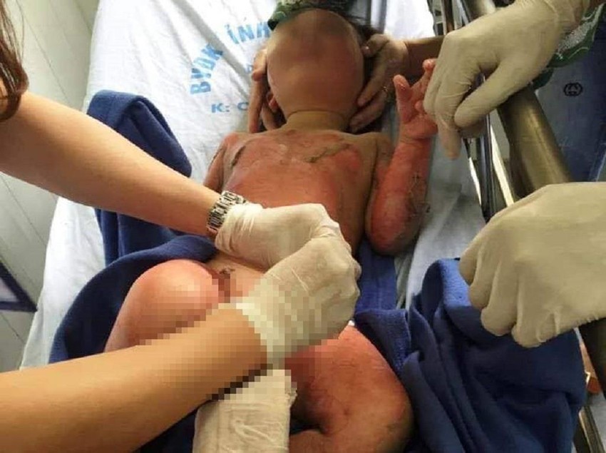 An 8-year-old boy suffered severe burns from an alcohol-based sanitizer available in many families - Photo 1.