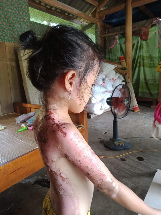 Ph&uacute; Thọ: C&ocirc;ng an v&agrave;o cuộc vụ b&eacute; g&aacute;i bị h&agrave;ng x&oacute;m dội cả ấm nước s&ocirc;i v&agrave;o người - Ảnh 1.