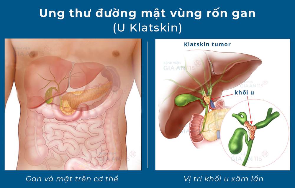 34 tuổi đã mắc căn bệnh ung thư thường chỉ gặp ở người trên 60: 3 triệu chứng cần lưu ý - Ảnh 2.