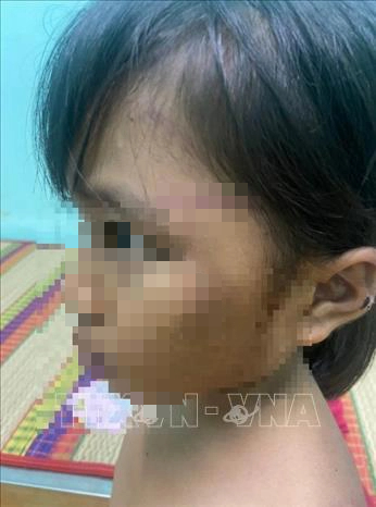 Xác minh việc bé gái nghi bị bạo hành ở Bình Phước - Ảnh 1.
