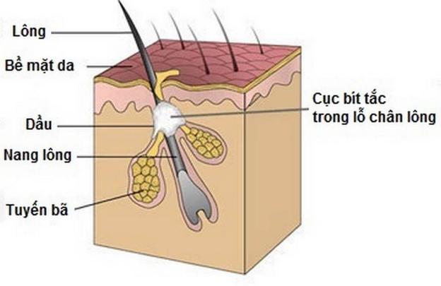 Cách làm sạch và ngăn ngừa tắc lỗ chân lông - Ảnh 1.