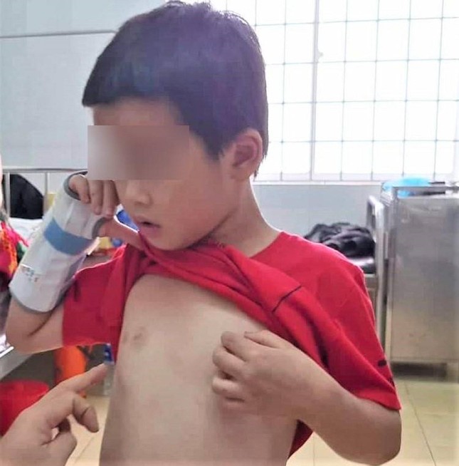 Diễn biến mới nhất về sức khỏe bé trai 9 tuổi bị bố ruột đánh đập dã man - Ảnh 1.