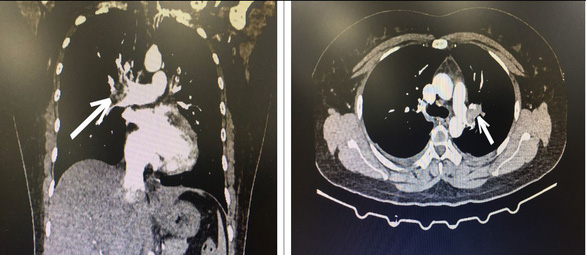 Tắc động mạch phổi vì uống 15 viên thuốc tránh thai khẩn cấp mỗi tháng - Ảnh 1.