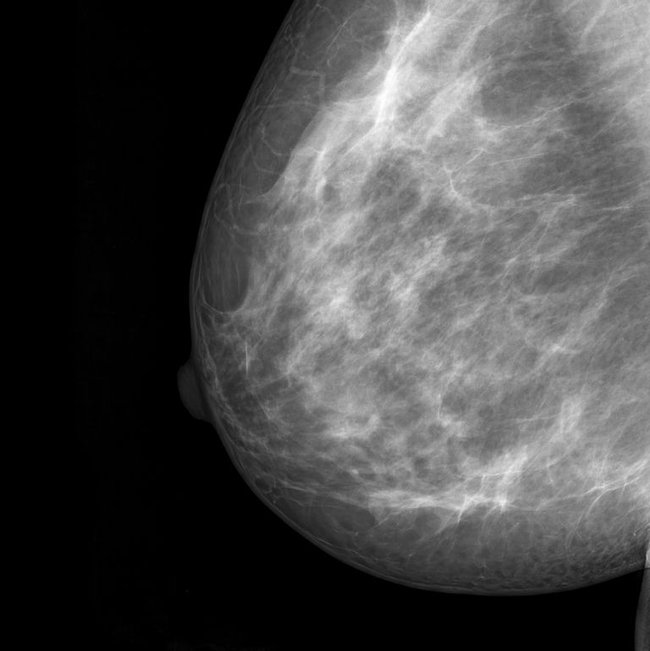 With these 7 factors in life, you have a higher risk of breast cancer - Photo 7.