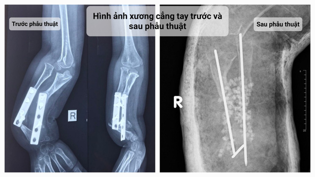 Bé gái 5 tuổi mắc bệnh khớp giả bẩm sinh 2 xương cẳng tay cực hiếm gặp - Ảnh 2.