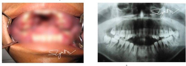 Nam sinh 16 tuổi bị viêm lợi cấp, vào viện mới phát hiện mắc ung thư máu - Ảnh 1.