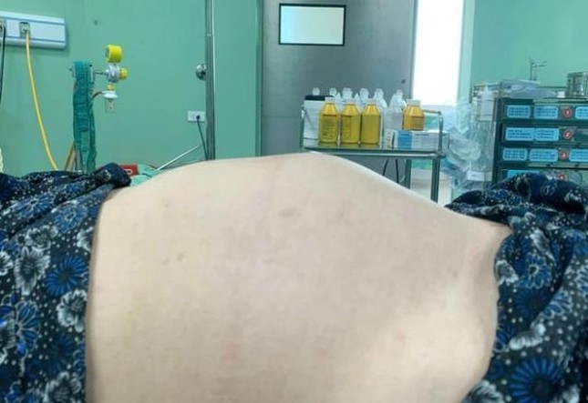 Thiếu nữ 18 tuổi bụng to như mang thai 7 tháng, không ngờ u buồng trứng khủng - Ảnh 1.