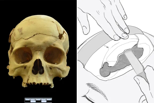 Phát hiện ca phẫu thuật mổ sọ kỳ lạ cách đây 2.700 năm, trước cả thời danh y Hoa Đà