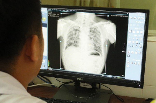 Vụ nhiều công nhân mắc bệnh bụi phổi tử vong: Khám, điều tra bệnh nghề nghiệp cho công nhân - Ảnh 4.
