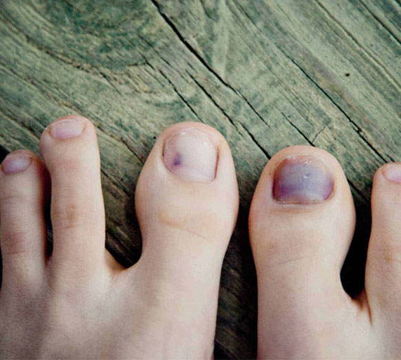 5 điều khác lạ ở chân có thể là tín hiệu cảnh báo mỡ máu cao - Ảnh 2.