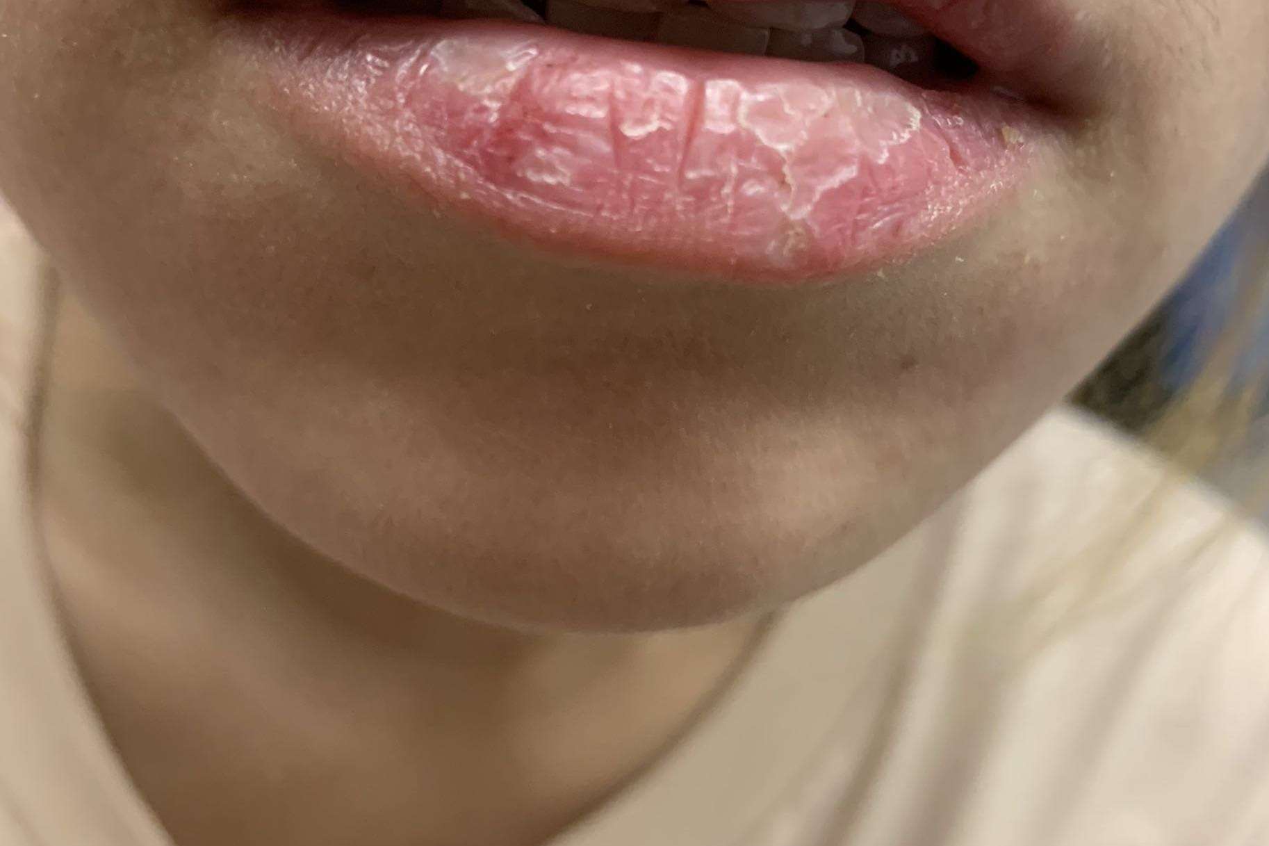 Đánh son hơn 10 lần/ngày, môi của cô gái 23 tuổi nứt nẻ như vỏ cây - Ảnh 1.