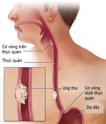 Người đàn ông bị ho uống thuốc mãi không khỏi, đi khám bàng hoàng phát hiện mắc căn bệnh khiến 3.000 người tử vong mỗi năm - Ảnh 1.