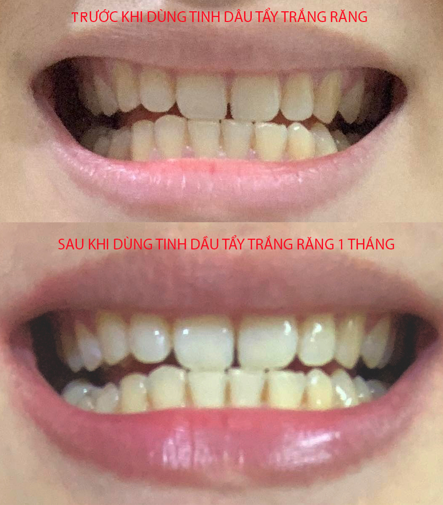 Trải nghiệm 1 tháng dùng tinh dầu trắng răng: Kết quả không như là mơ - Ảnh 6.