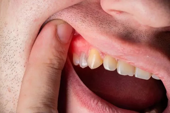 3 màu sắc ở răng là dấu hiệu cảnh báo căn bệnh dẫn đến rụng răng, thậm chí ung thư - Ảnh 2.
