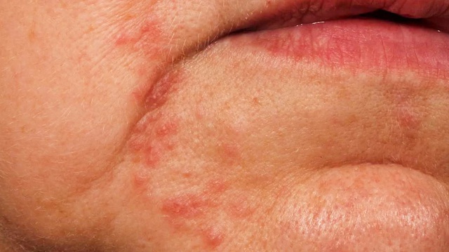 Thấy 6 dấu hiệu này trên khuôn mặt, hãy cẩn thận với gan nhiễm mỡ - Ảnh 3.