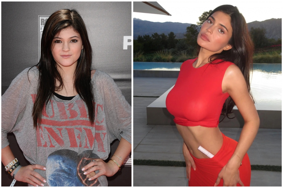 Kylie Jenner bị chỉ trích nói dối khi tuyên bố không phẫu thuật thẩm mỹ - Ảnh 2.