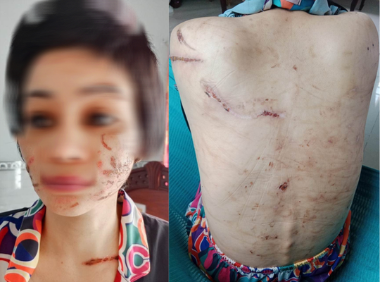 Chi chít vết thương trên cơ thể người vợ mang thai bị chồng bạo hành dã man - Ảnh 2.