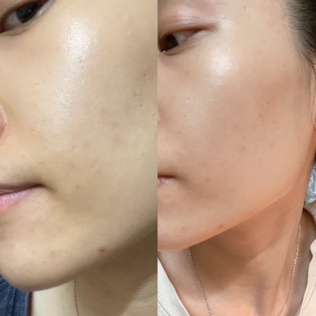 Đánh giá cặp đôi giúp giảm mụn chiết xuất cà rốt: Hiệu quả thấy rõ chỉ sau 2 tuần, tuy nhiên vẫn có 1 điểm trừ nhỏ - Ảnh 4.