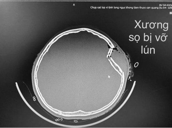 Xuyên đêm cấp cứu bệnh nhi 12 tuổi ngã cao vỡ lún xương sọ - Ảnh 1.